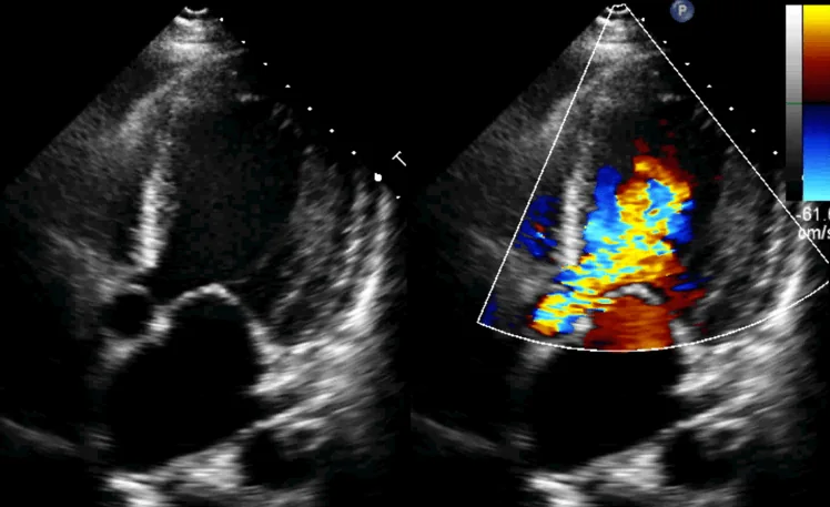 Echocardiography