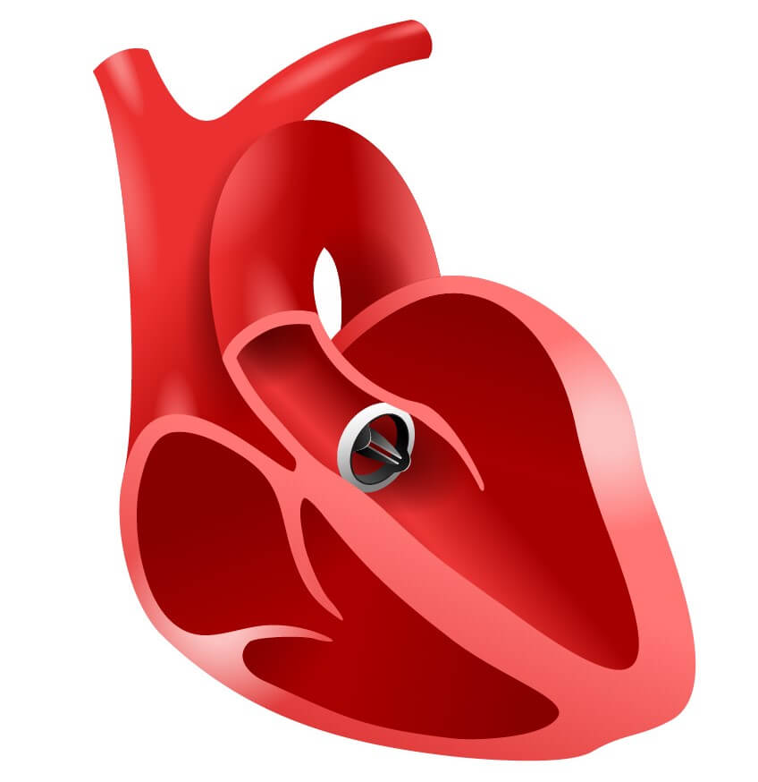 Heart Valve Replacement Surgery